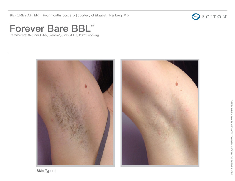 Permanent Hair Reduction Treatment | Laser Hair Removal Near Me