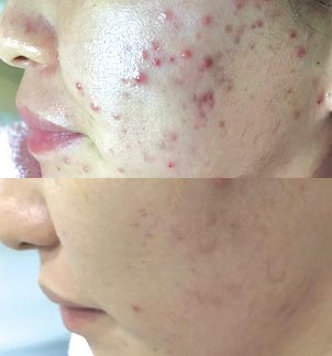 Agnes-Acne cheeks before and after
