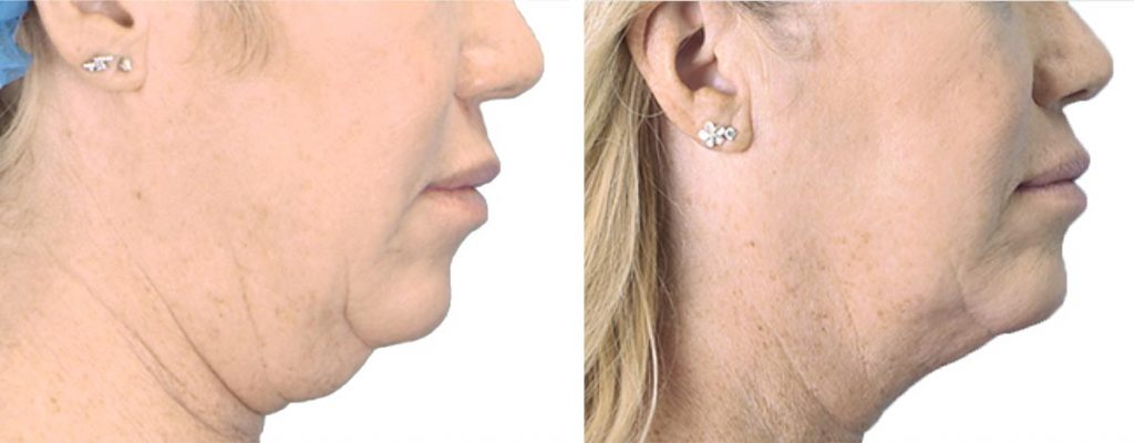 Non-Surgical Facelift before and after