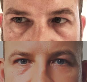 RF Microneedling men before and after