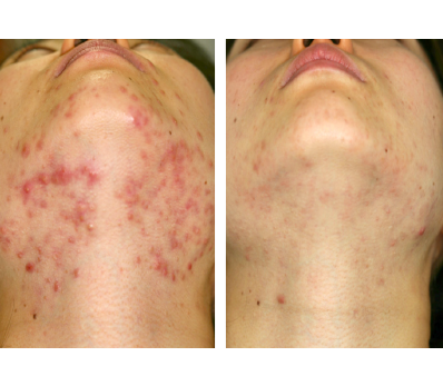 Agnes-Acne Neck before and after