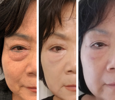 RF Microneedling before and after