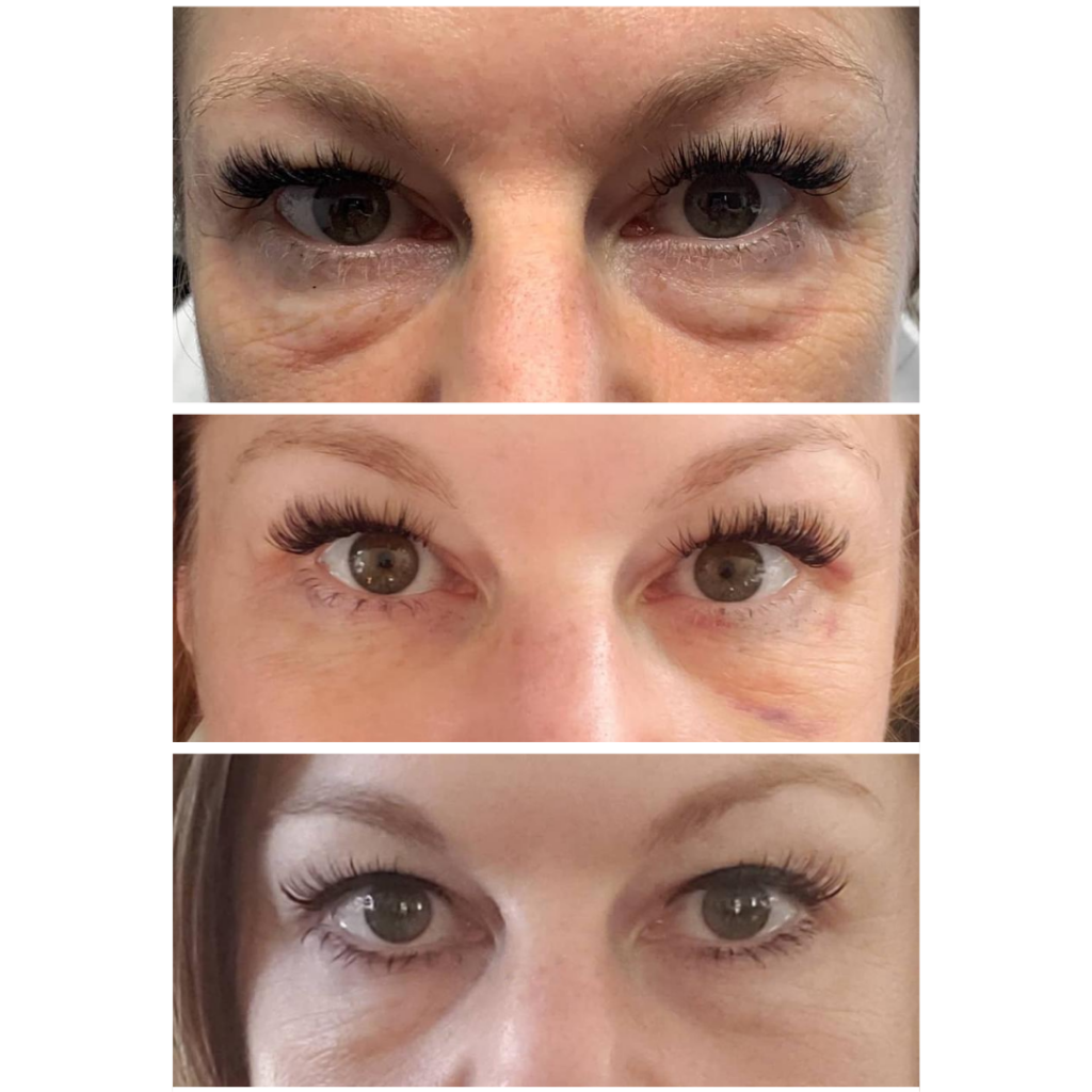 RF Microneedling eyes before and after