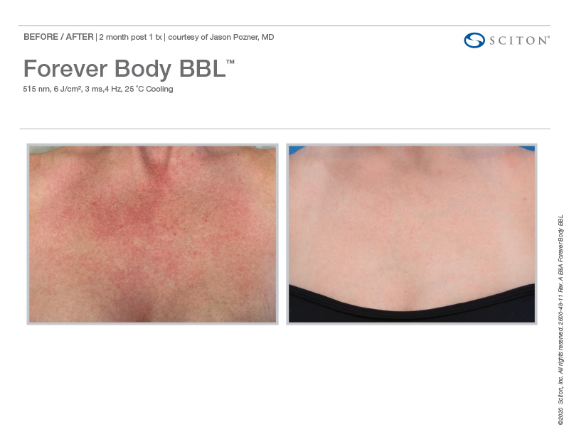 Forever-Body-BBL before and after
