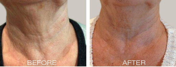 Scarlet-Neck before and after