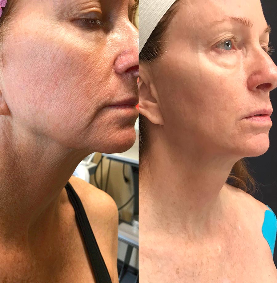 Skin Tightening woman before and after