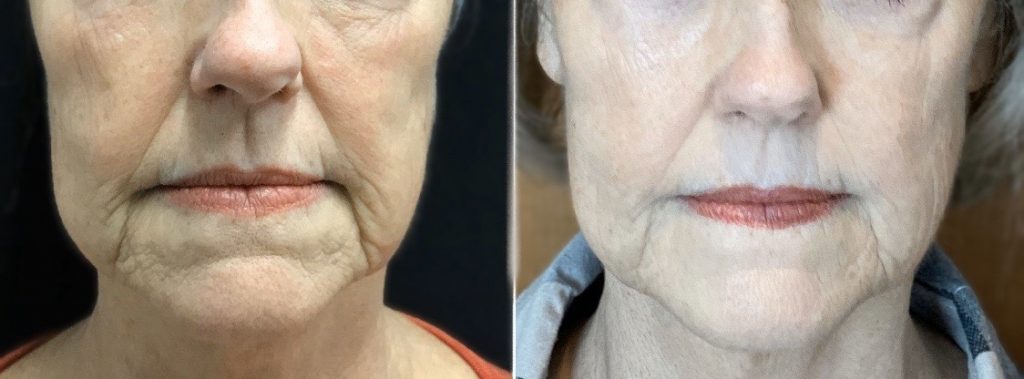 Skin Tightening before and after