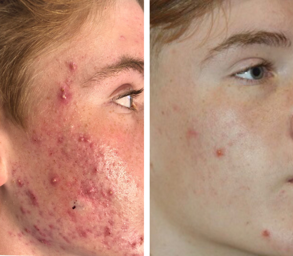 Agnes-Acne side face before and after
