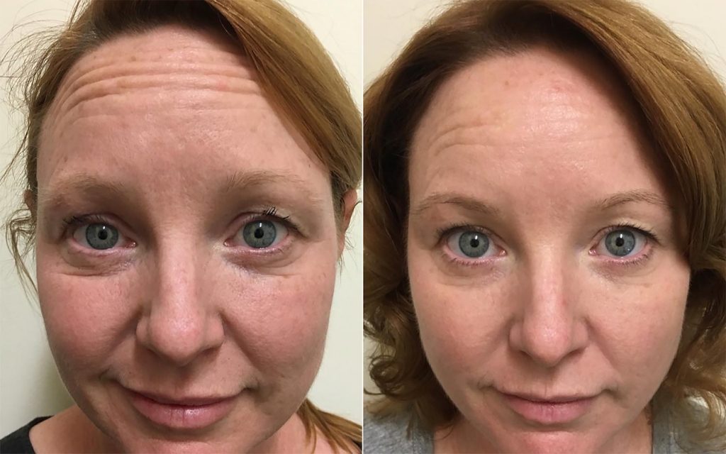 RF Microneedling before and after 2