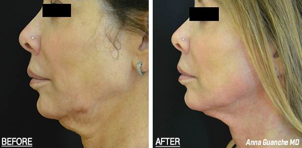 Non-Surgical Facelift before and after 2