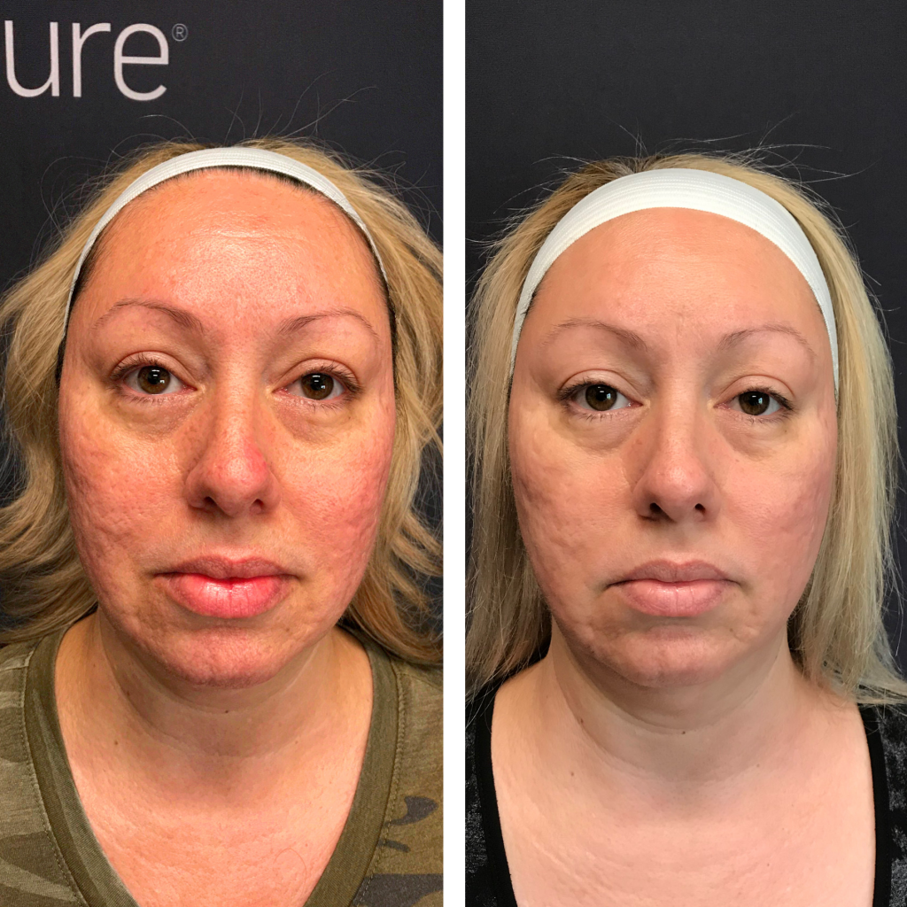Rosacea face before and after