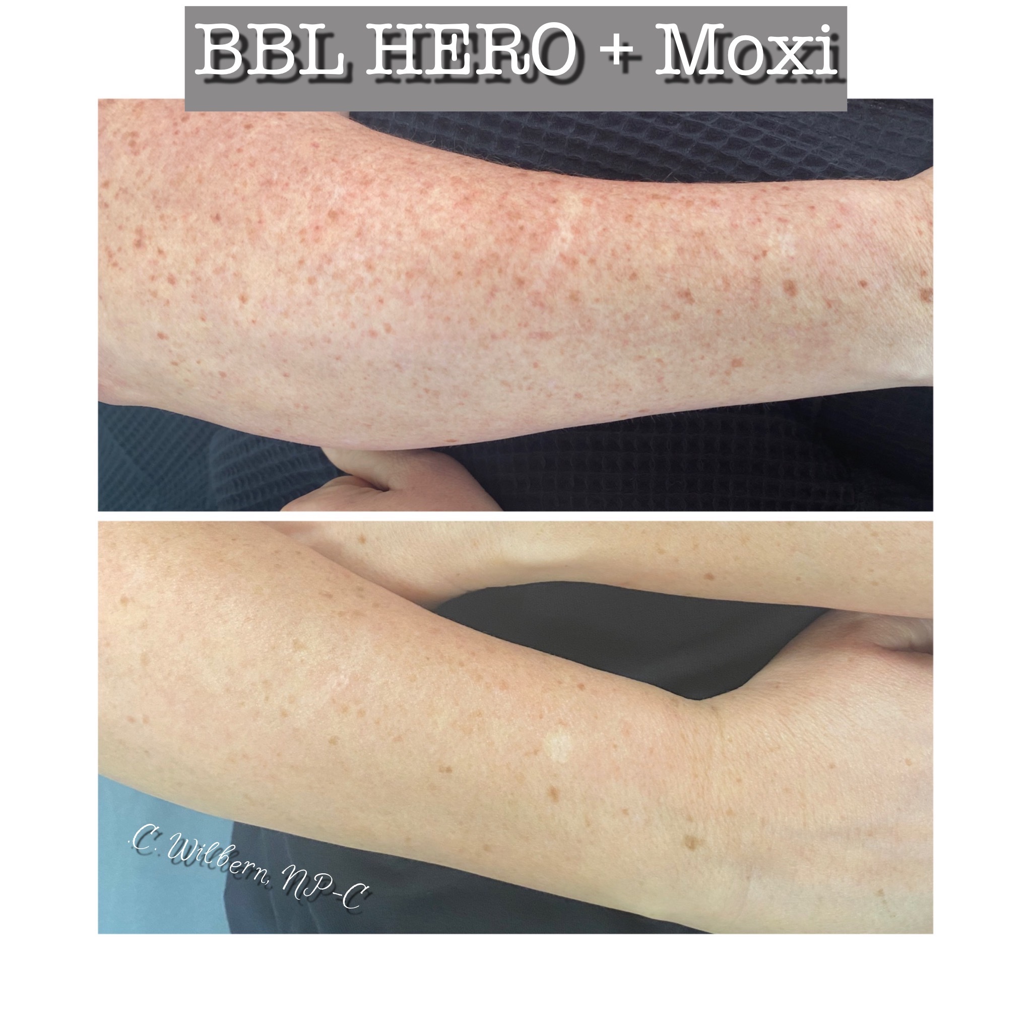 BBL Hero+ Moxi before and after